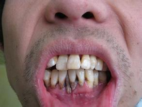 牙齿有缝隙怎么矫正,牙齿清洁缝隙的有效方法