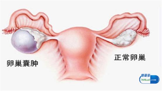 囊肿是肿瘤的意思吗,腰部囊肿会变成肿瘤吗