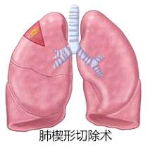关于癌症你一定要知道的事,肺癌家属应该知道哪些问题