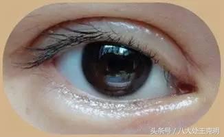 双眼皮有肉条怎么消肿最快,双眼皮术后疤痕怎么能彻底消除