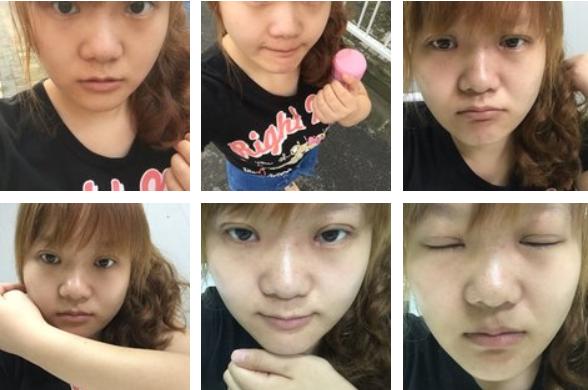 割双眼皮的危害和后遗症,拆双眼皮线痛吗