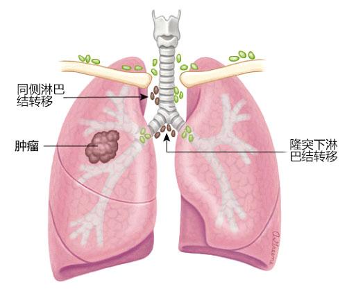 关于癌症你一定要知道的事,肺癌家属应该知道哪些问题