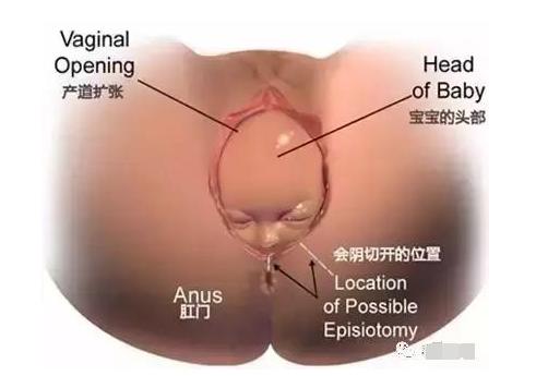 顺产撕裂缝合打麻药吗,顺产有轻微撕裂医生说不用缝合