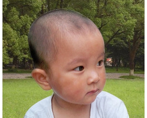 生了小孩之后得了白癜风会遗传吗,白癜风如何避免白癜风遗传给孩子