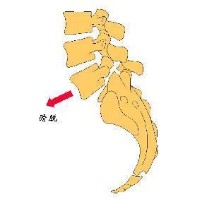 腰椎滑脱是怎么一回事儿？
