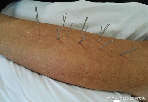 癌症治疗西医和中医治愈比例,癌症治疗有哪三种手段