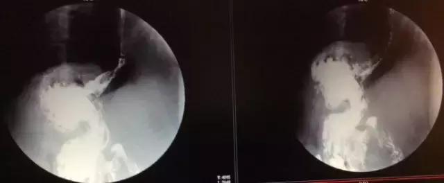 胃底贲门中分化腺癌怎么来根治,胃底贲门低中分化腺癌能治愈吗