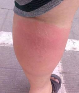 胳膊肿了导致手麻怎么回事,胳膊肿了摸着里面有个疙瘩