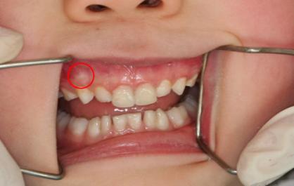 小孩牙疼能吃大人的止痛药吗,孩子晚上牙疼能吃消炎药吗