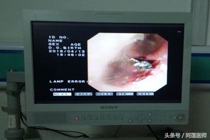 掏耳屎耳朵掏烂疼了好几天,掏耳屎疼是怎么回事