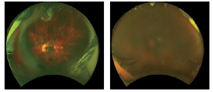 英国干细胞治疗,新英格兰医学杂志最新文章