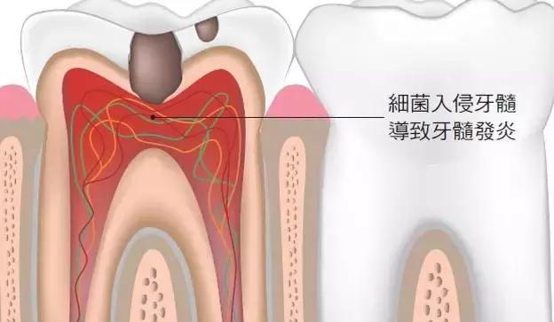 牙齿一跳一跳的疼,牙齿一跳一跳的疼痛怎么回事