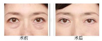 黑眼圈折磨我这么久，今天该认真聊聊了