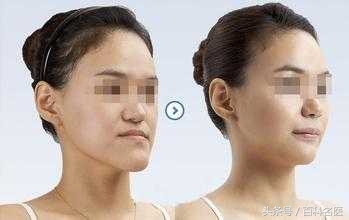 四种人矫正牙齿脸型变化是最大的,牙齿畸形矫正图片大全