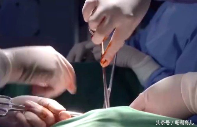 顺产生孩子剖腹产的真实流程,生小孩剖腹产和顺产哪个需要勇气