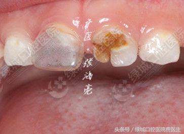 乳前牙透明冠修复大概要多久,乳前牙透明冠操作流程