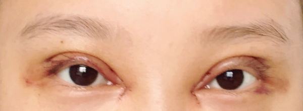 不认识的人看到我，完全看不出来做过双眼皮