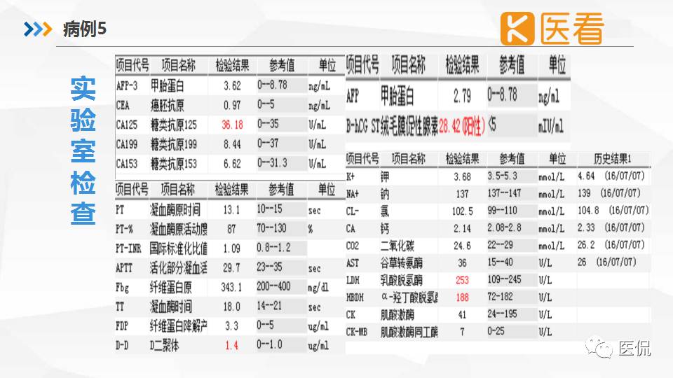 精原细胞瘤ct影像,精原细胞瘤影像特征