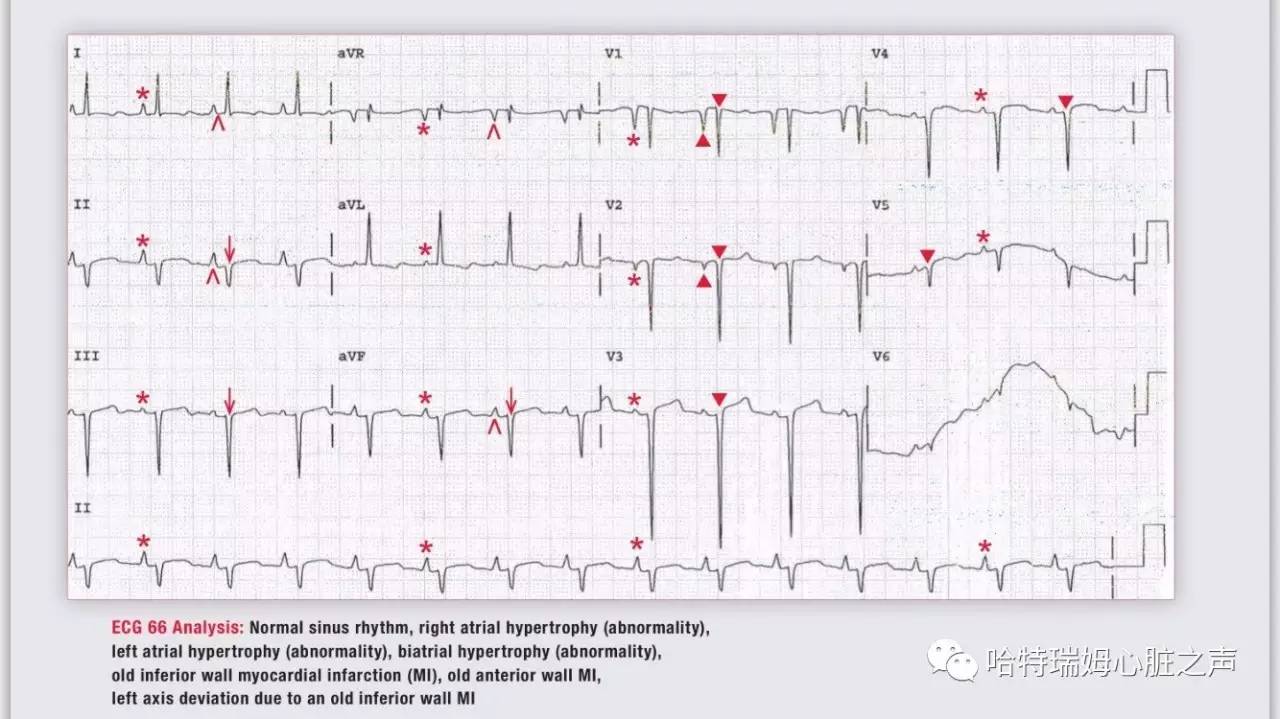 读心有术216,心电图出现双尖心室肥大