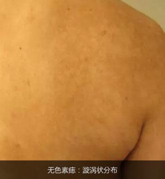 不是白癜风的白斑能查出是什么吗,不是白癜风的白点是啥