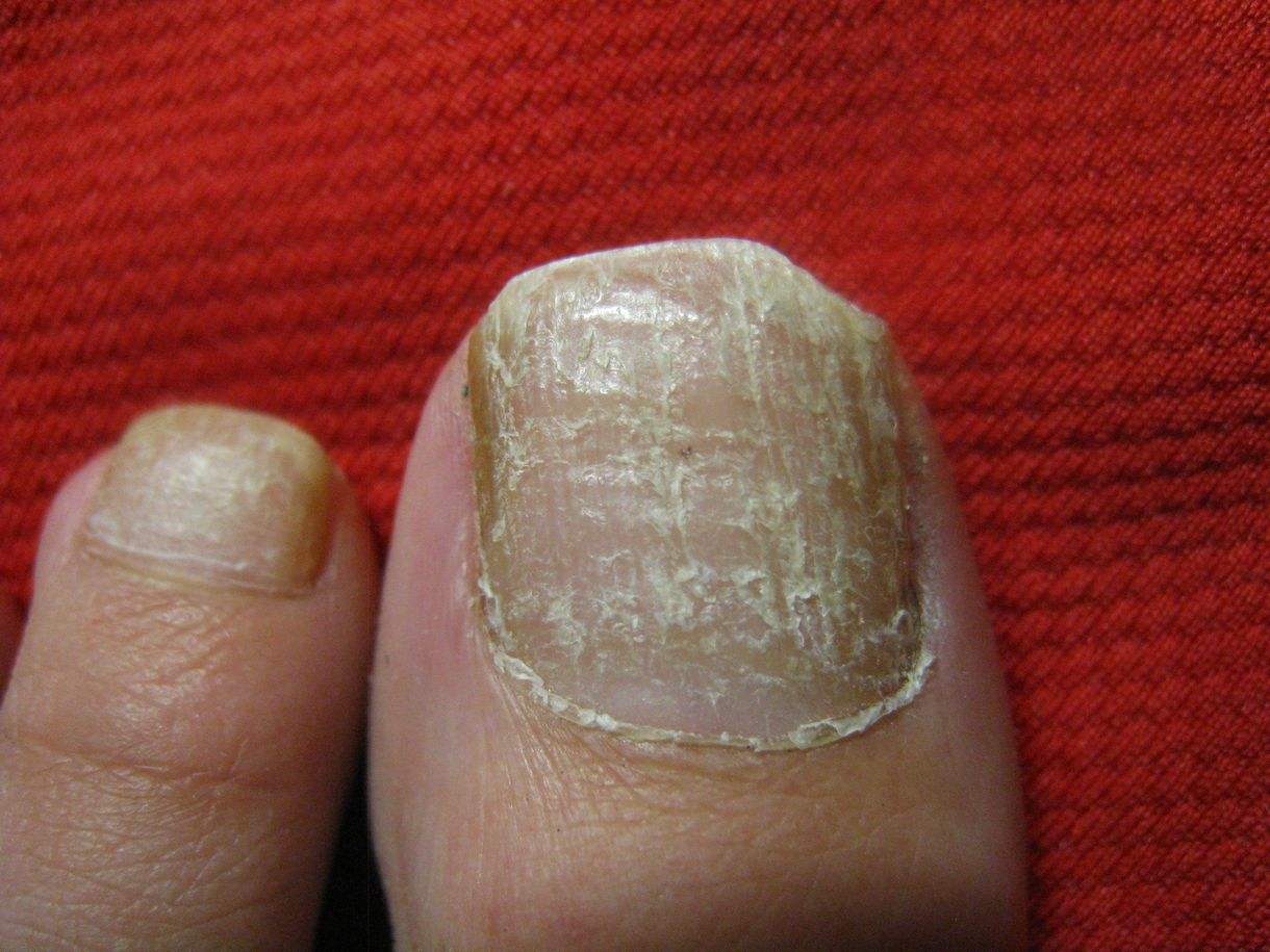 指甲被压了会感染吗,指甲被压紫了碍事吗