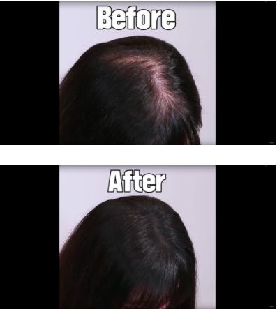 为什么没人敢去植发,为什么很多人都没有去植发