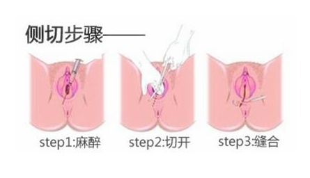 顺产侧切如何护理好得快,顺产侧切的伤口怎么护理