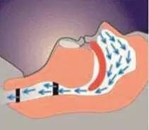 打鼾会引起心梗吗,打鼾会致死吗