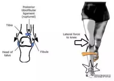 崴脚了四个多月反复不好,崴脚反复扭伤中医怎么治