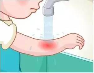 狗狗咬伤主人怎么处理伤口,猫狗咬伤如何正确处理