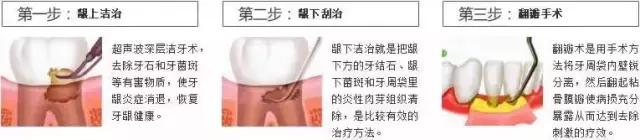 牙周病的治疗的4个程序,牙周病怎么治疗最有效好得快