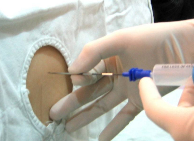 剖腹产后40天刀口针扎似的痛,剖腹产背上为什么扎针