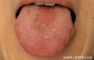 宝宝地图舌是缺维生素吗,11个月宝宝有地图舌
