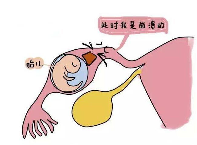 突然小腹剧痛，年轻女子以为是痛经却不知宝宝悄悄“来过”