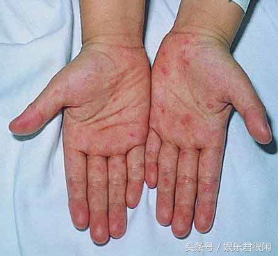 手足口病可不可怕,手足口病感染的话一般要多久发现