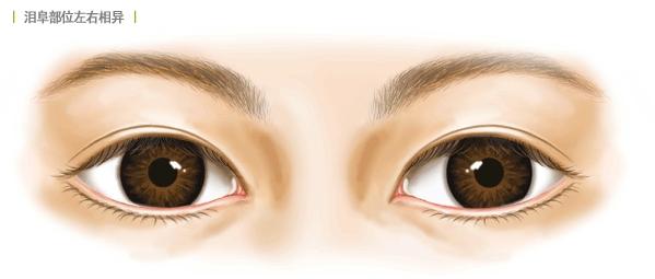 眼部整形怎么样,眼部整形注意事项有哪些