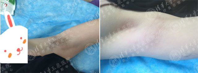 激光脱毛后的真实感受,激光脱毛一年后的真实感受