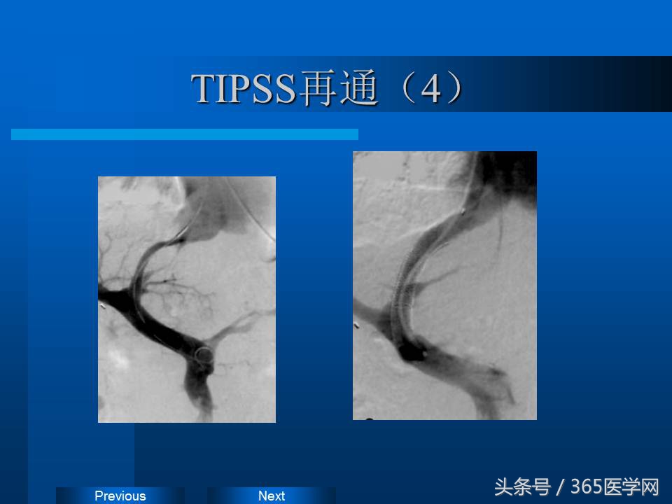 崔进国：消化道出血的介入治疗