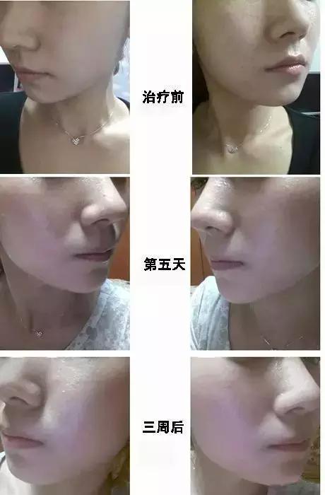 少女灯泡肌,灯泡肌美肤