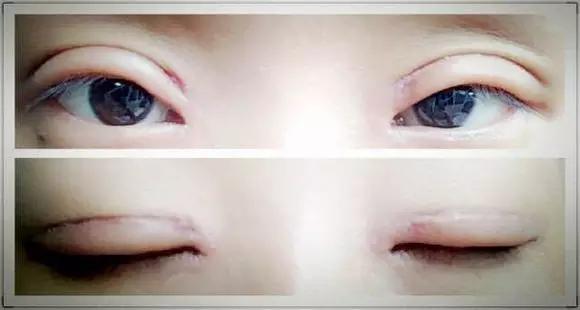 割双眼皮肉条感怎么修复消除,割双眼皮三个月了还有肉条怎么办