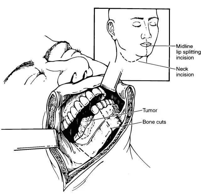 关于舌癌的新闻又一次刷屏，我想起了一年前离开的那位老人