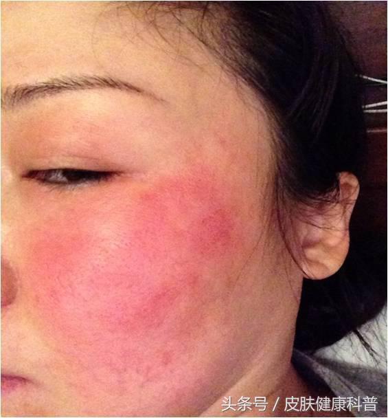 面部皮肤屏障受损要怎么修复,激素脸怎么修复皮肤屏障