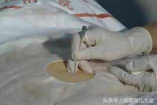 羊水穿刺3条染色体异常严重吗,三代做羊水穿刺发现畸形怎么办