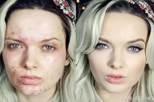 祛痘方法有哪些怎么祛痘最有效,祛痘怎么这么难啊