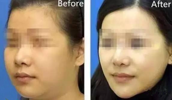 瘦脸针都拯救不了的大饼脸,瘦脸针不能一劳永逸吗