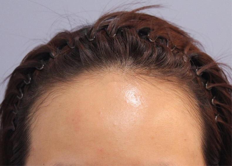 防止发际线后移习惯,让发际线前移的习惯