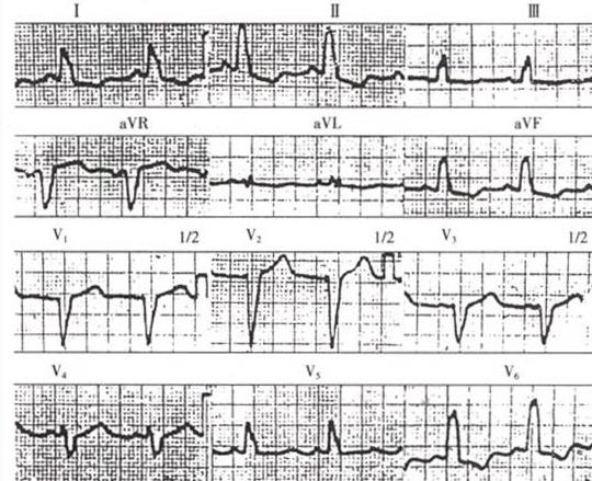 发热咳嗽但是不发烧,发热乏力干咳不明原因肺炎