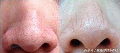 治疗黑头最有效的方式,有效治疗黑头的方法