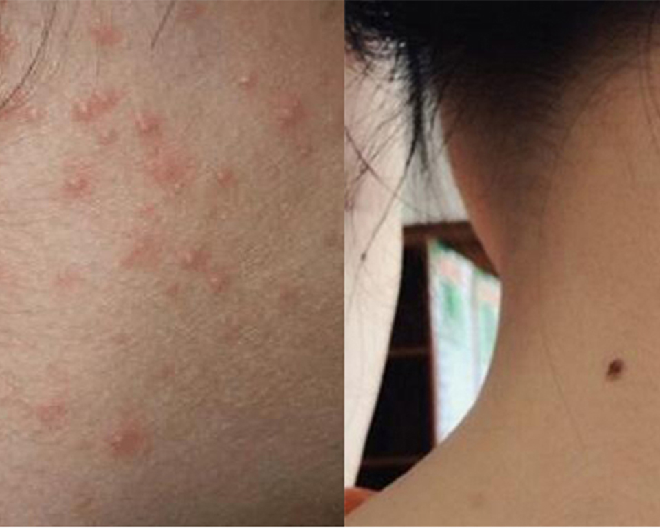 耳朵脖子后面长痘痘怎么办,脖子后面长痘痘一碰就疼