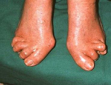 风湿全解｜夏季风湿关节炎危害大，如何有效治疗和预防？